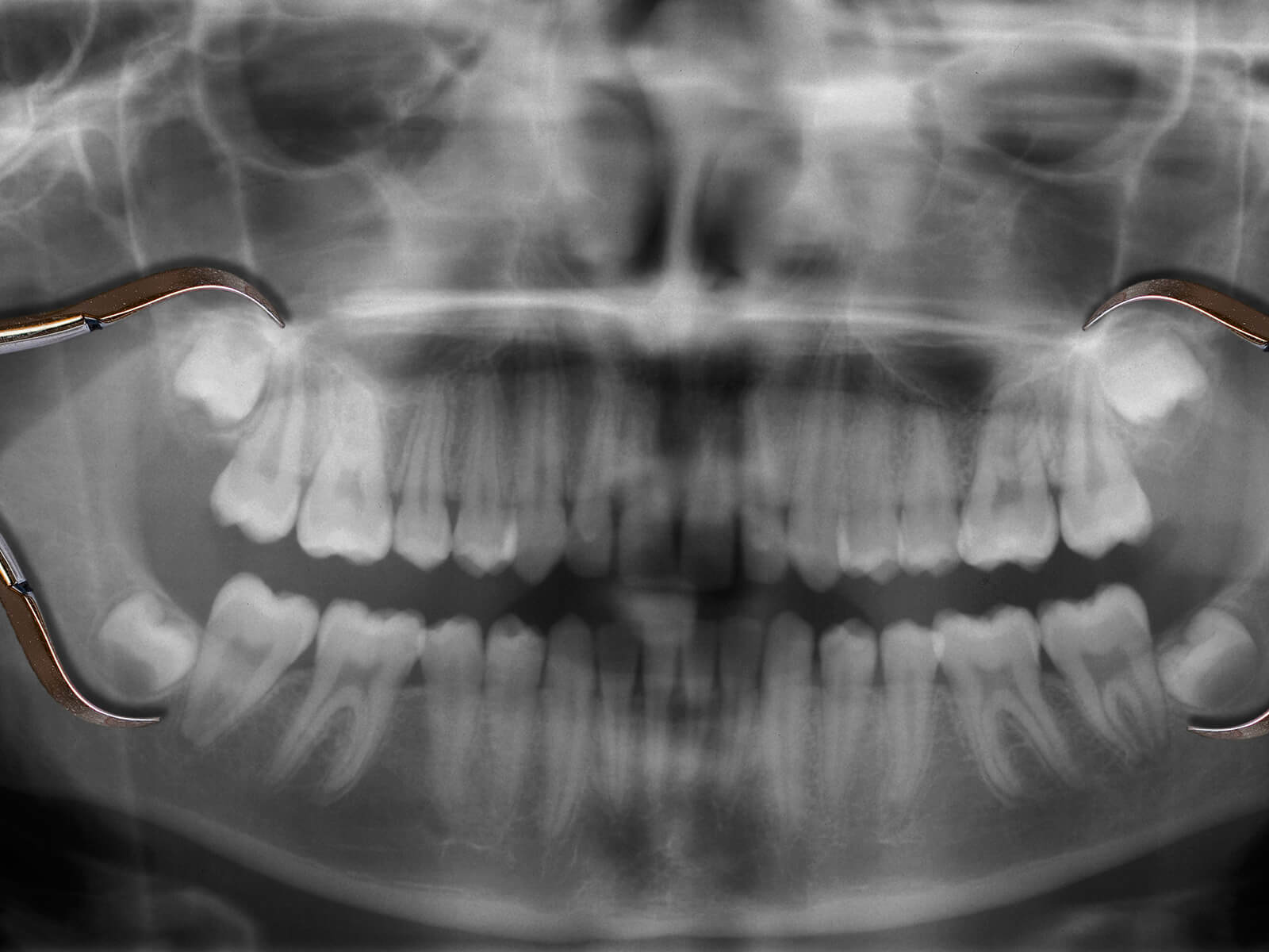 How to clean wisdom teeth?