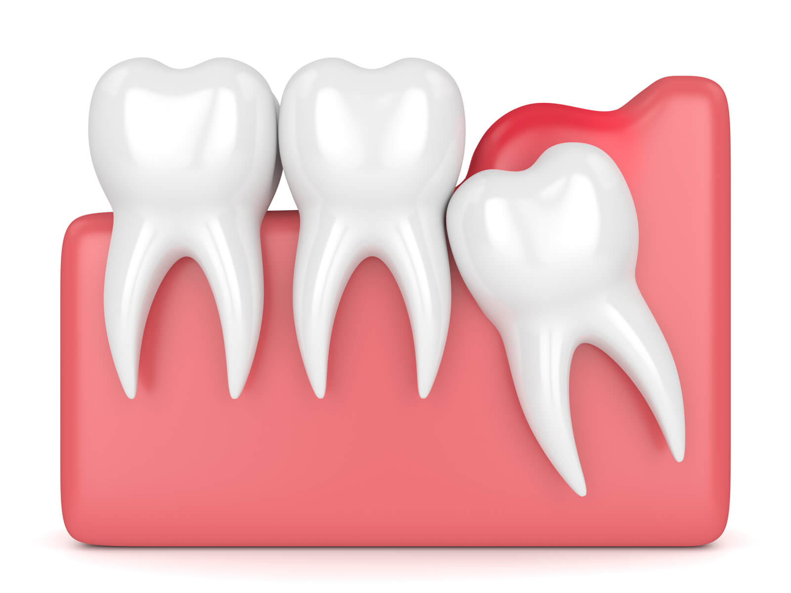 Pericoronitis: Types, Causes, Signs, Symptoms, Treatments?