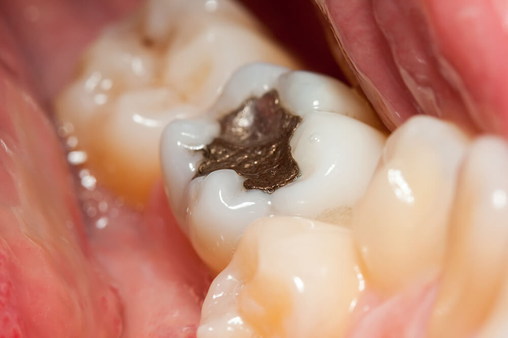 How to take care of dental fillings