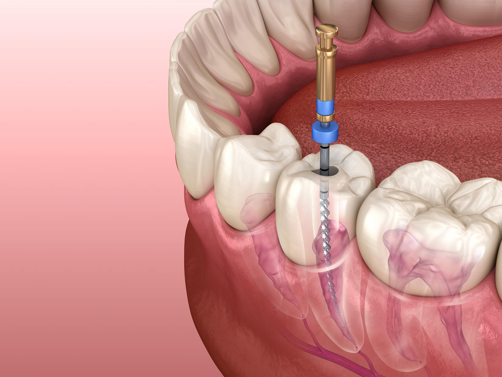 What are the risks of root canal?