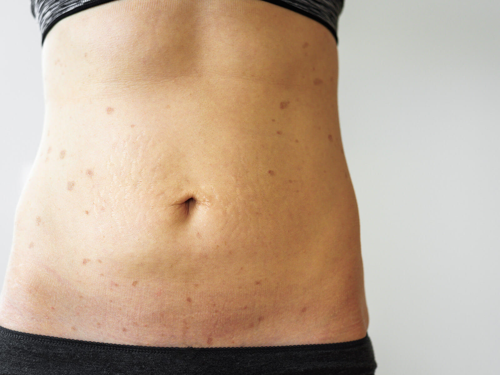 What is Lichen Planus?