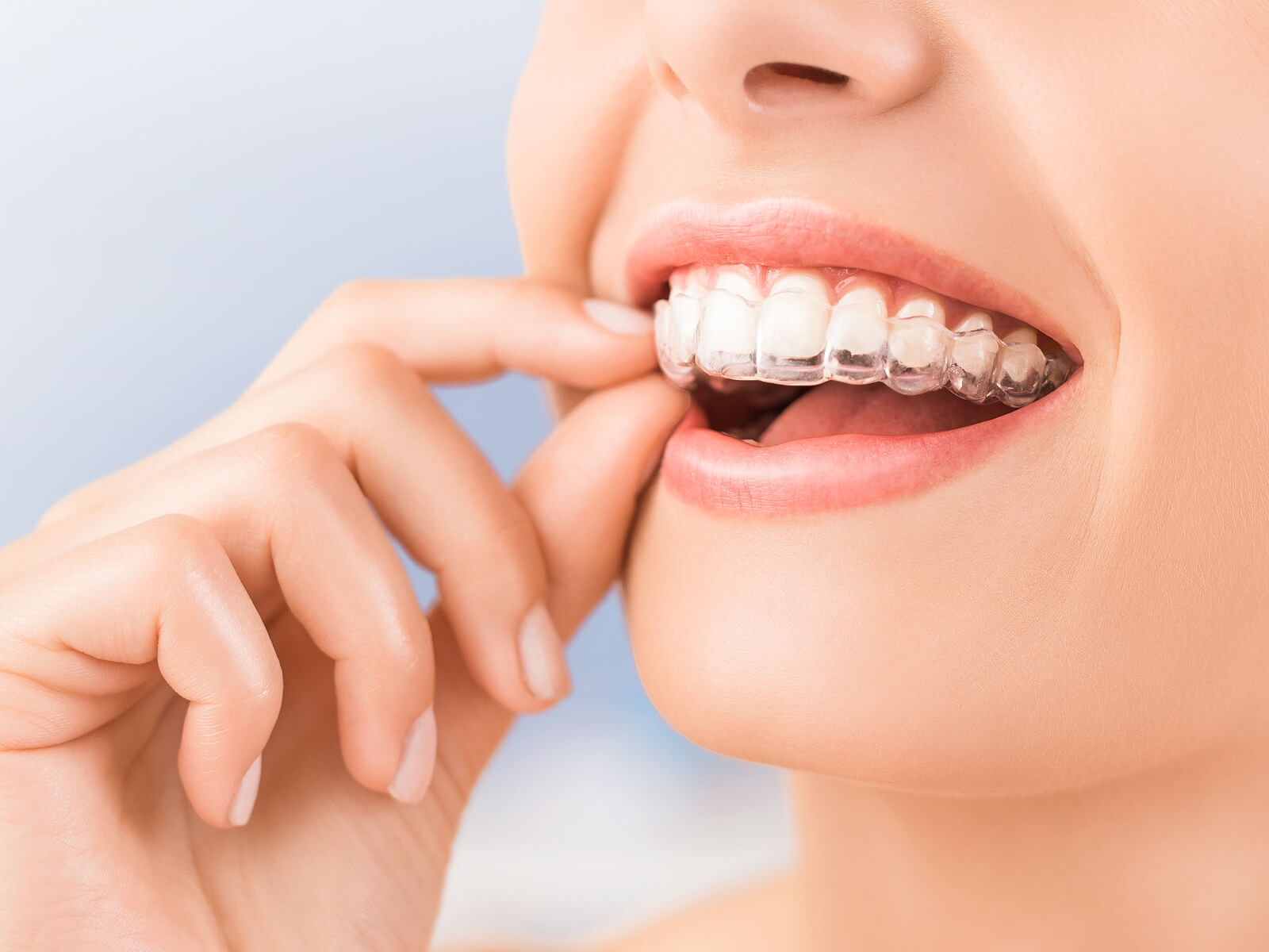 How long will 14 Invisalign trays take?