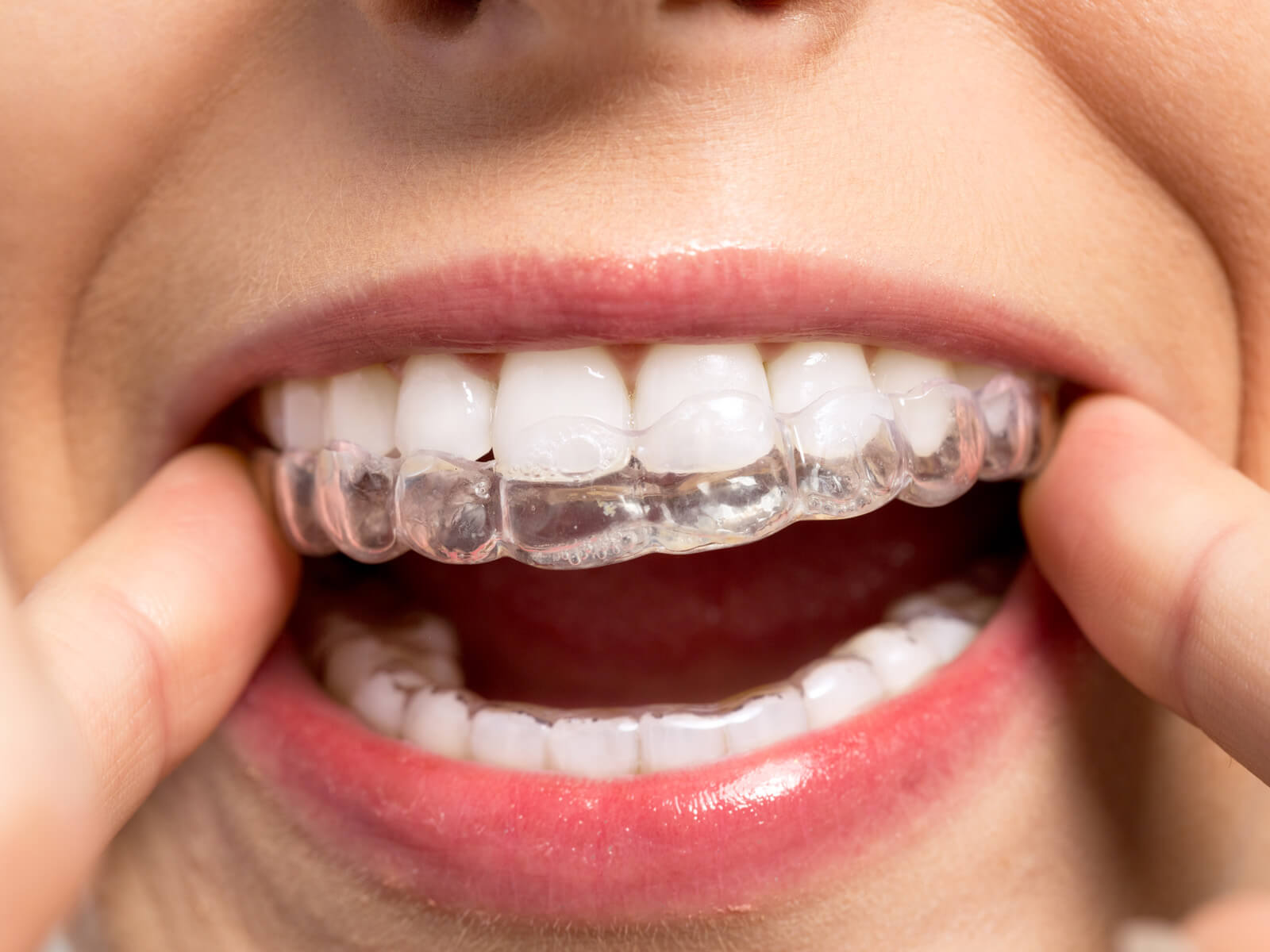 Can you rotate teeth with Invisalign?