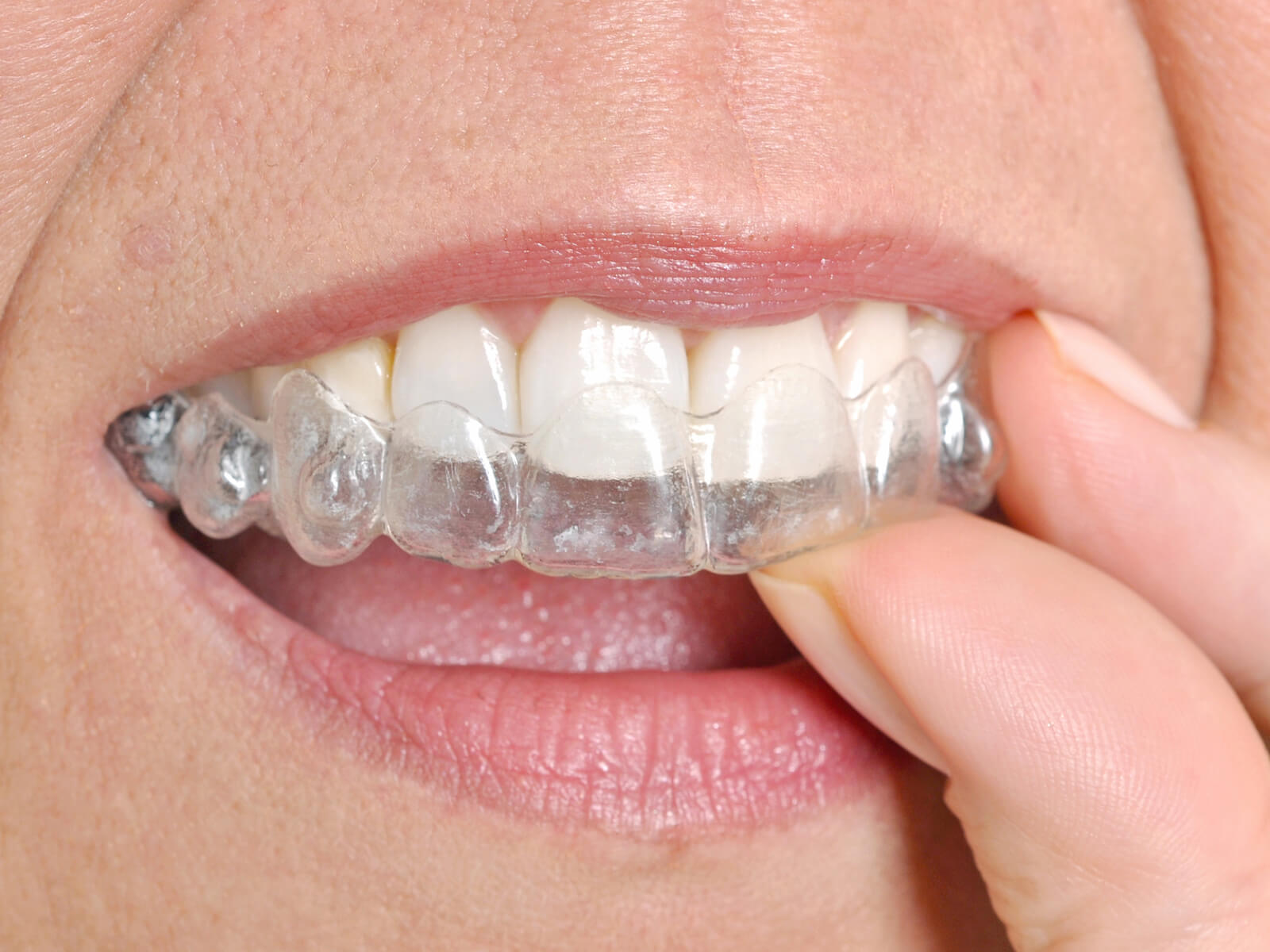 Why is it so hard to remove Invisalign?