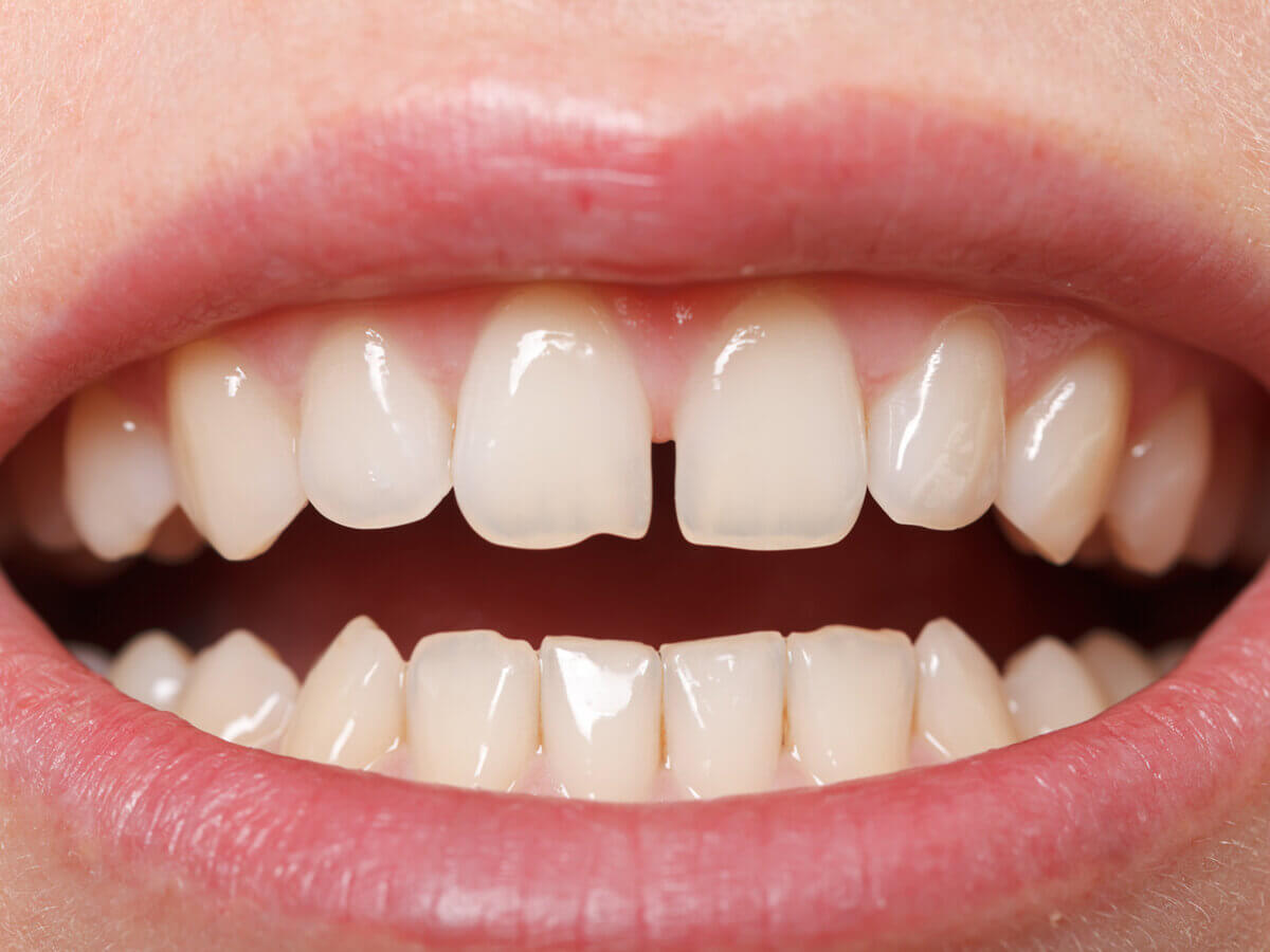 What Causes Tooth Gaps and How do we Treat Them?