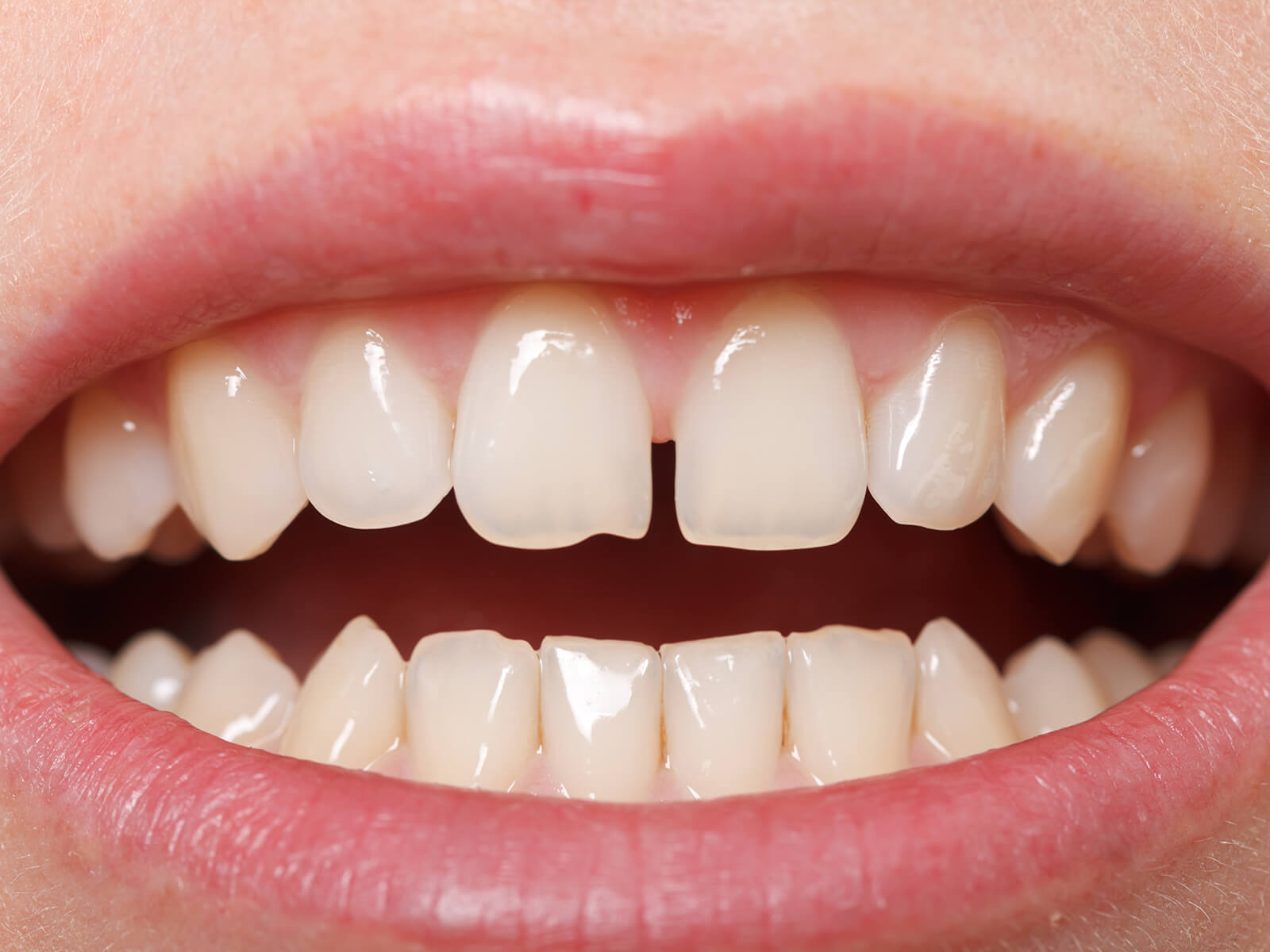 What Causes Tooth Gaps and How do we Treat Them?