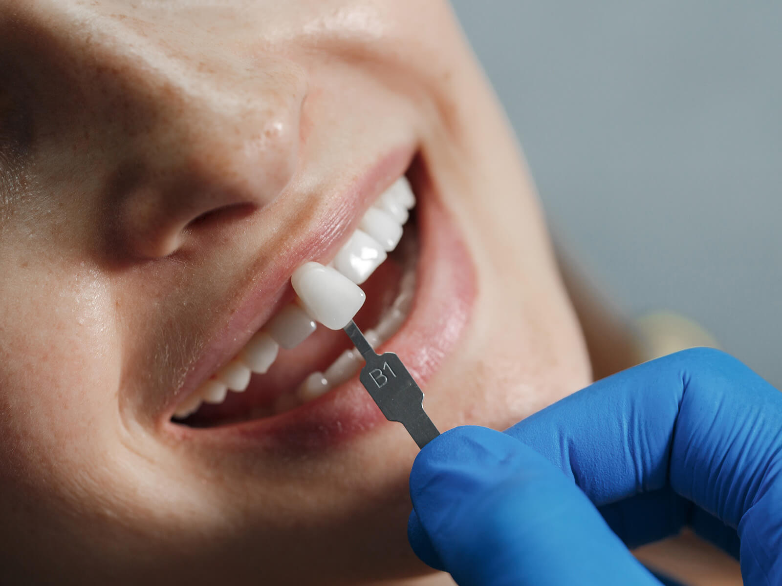 4 Cosmetic Options To Fix Small Teeth