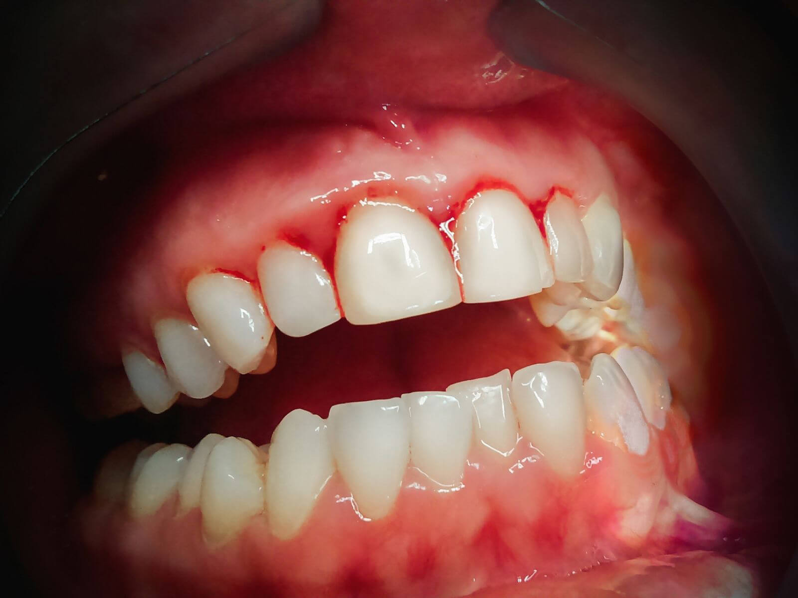 Why Are My Gums Bleeding When I Brush?