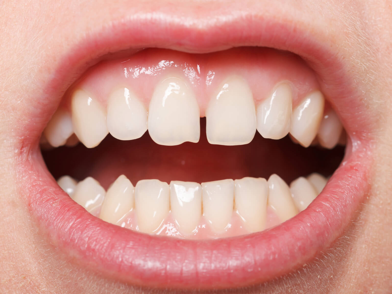 How Teeth Gap Filling Can Instantly Improve Your Smile