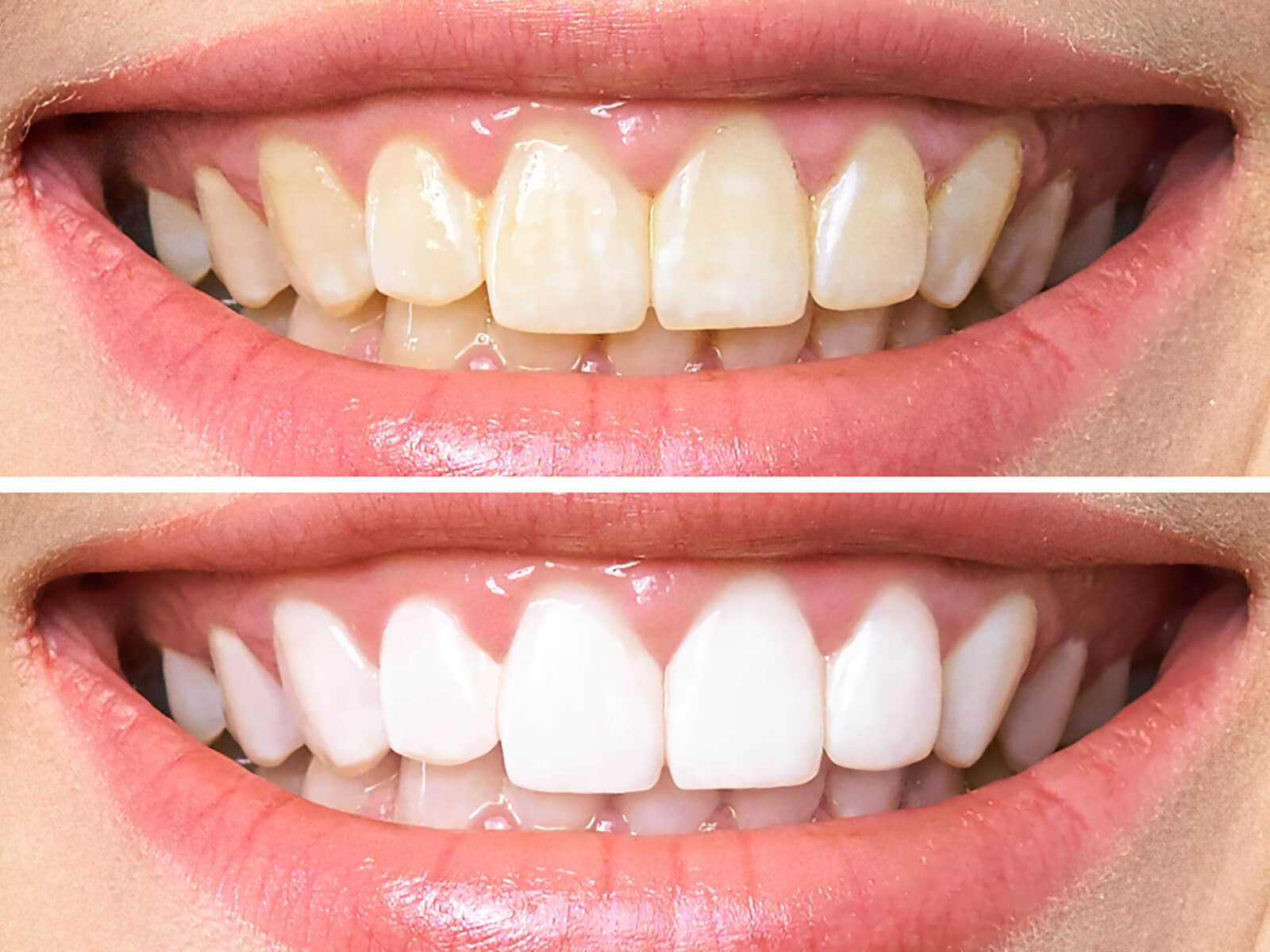 6 Things You Didn’t Know About Professional  Dental Whitening