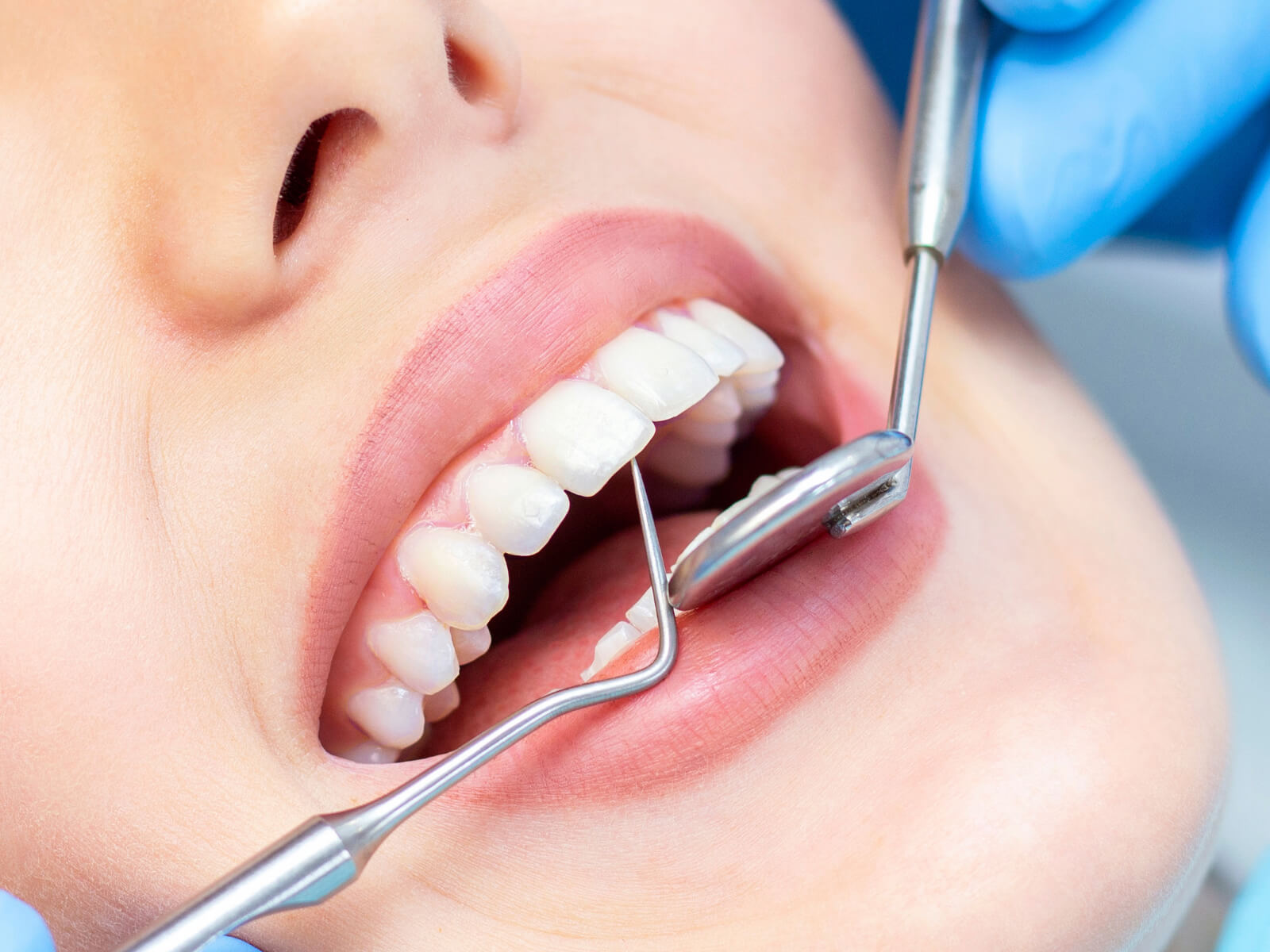 How To Know If You Need A Deep Dental Cleaning