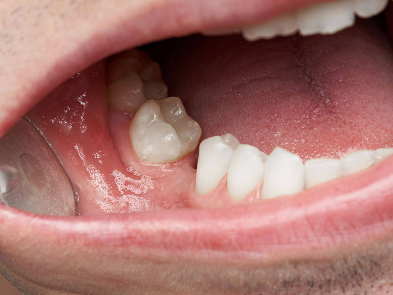 Why Replacing Missing Teeth Quickly Matters More Than You Think