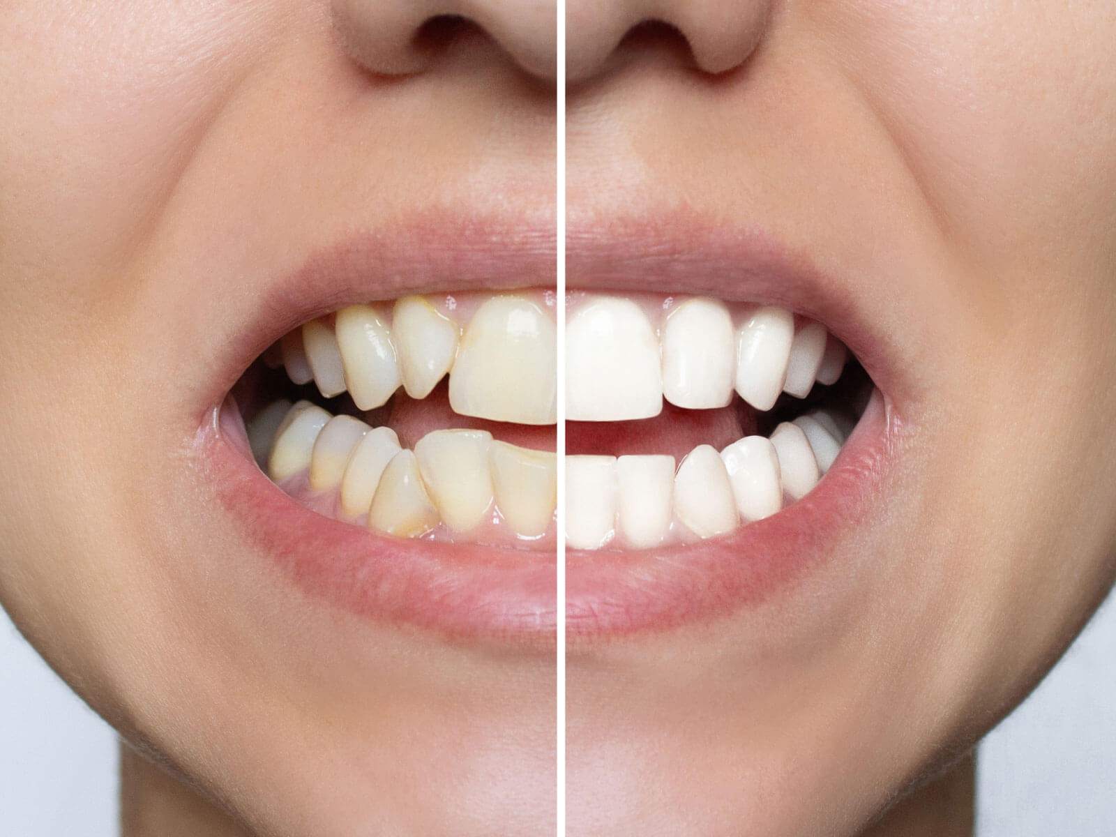 What Is the Cost of Teeth Straightening Treatment?