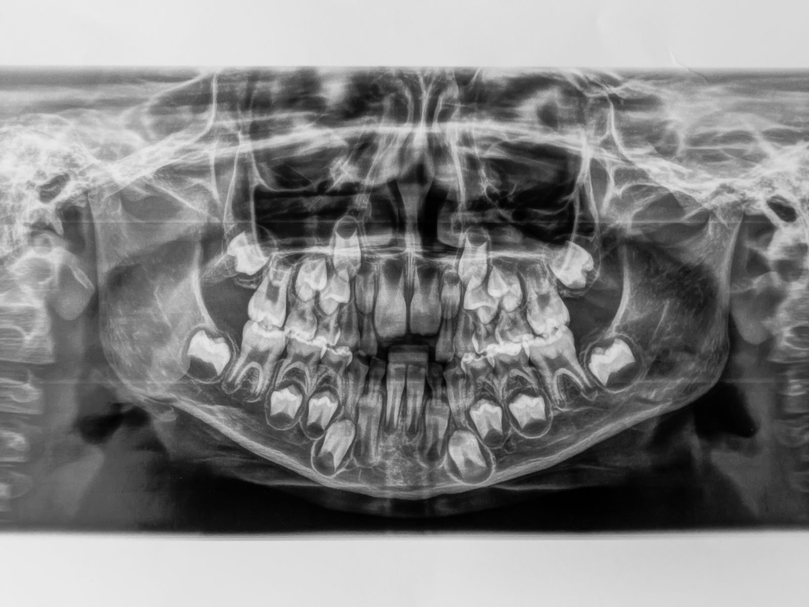 Impacted vs. Erupted Wisdom Teeth: What’s the Difference?