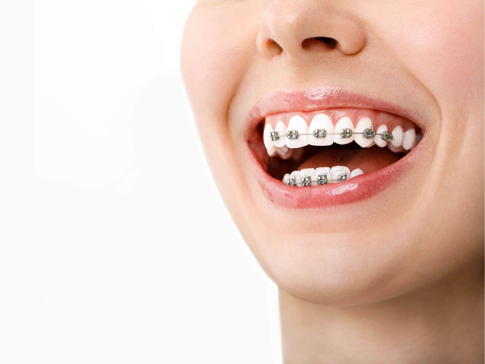 How Do Braces Move Teeth? Here’s the Science Explained