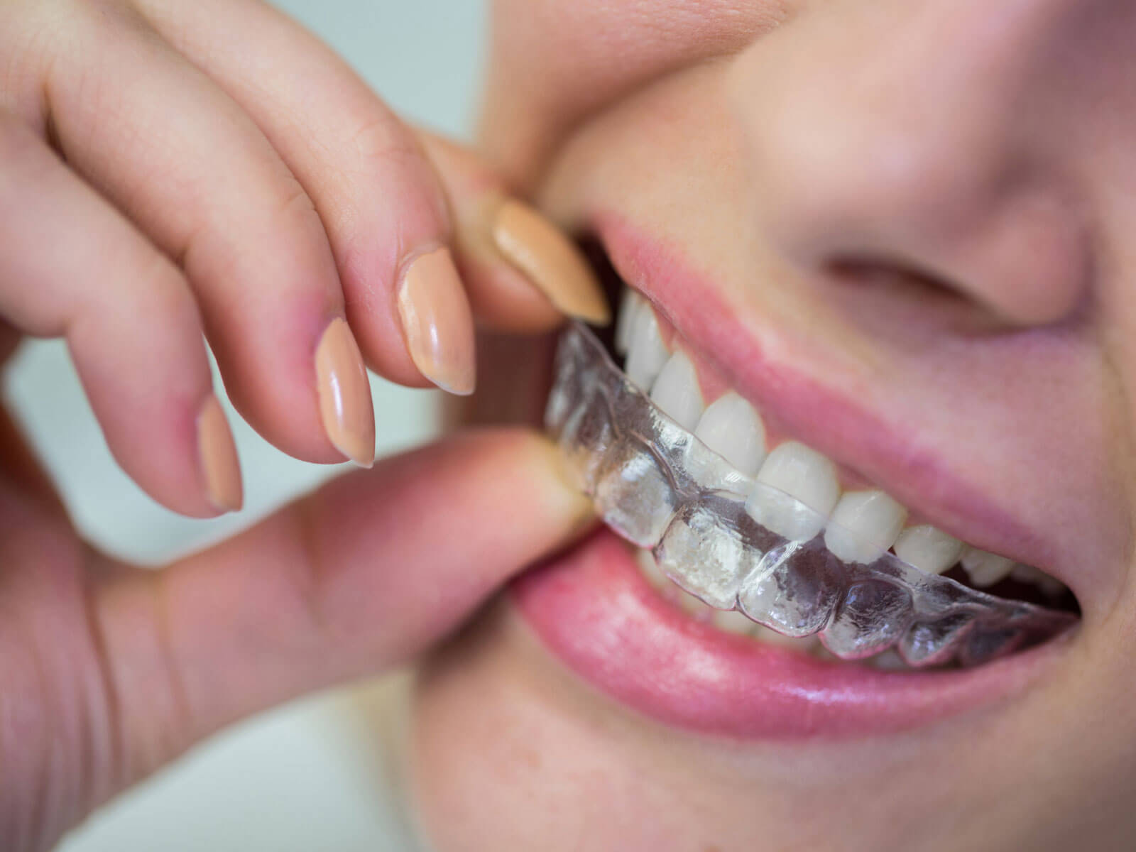 How Much Does Invisalign Cost in 2026? With and Without Insurance