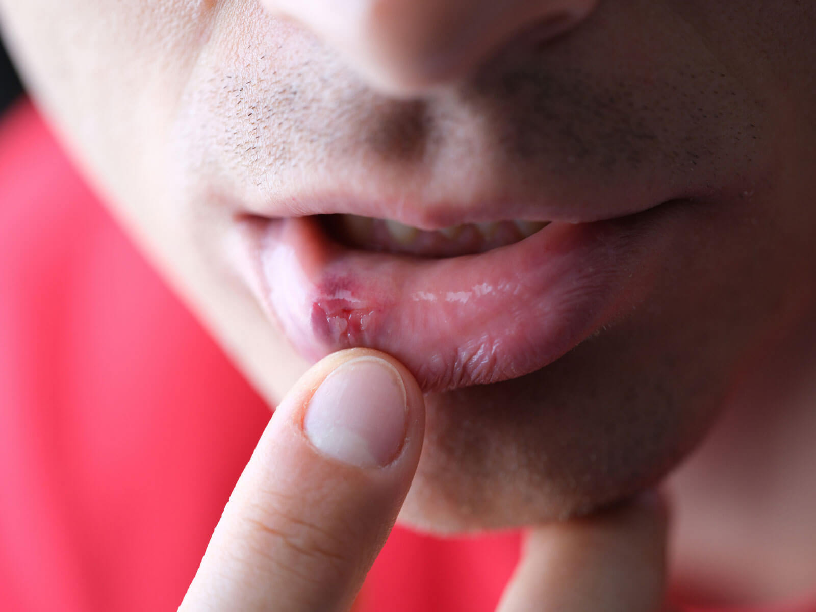 Canker Sores vs. Cold Sores: What’s the Difference?