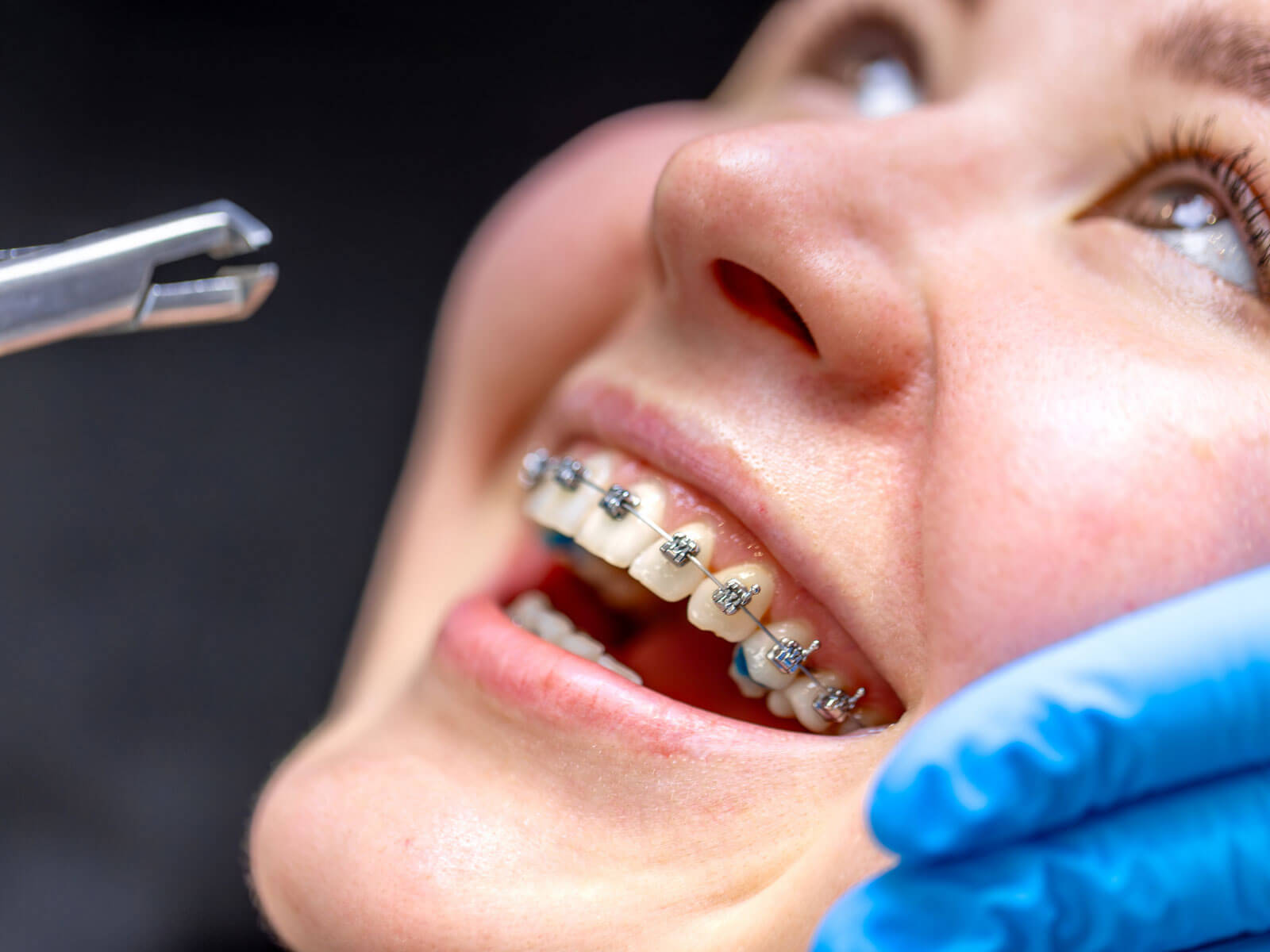 Ceramic Braces: Pros and Cons to Consider Before You Choose