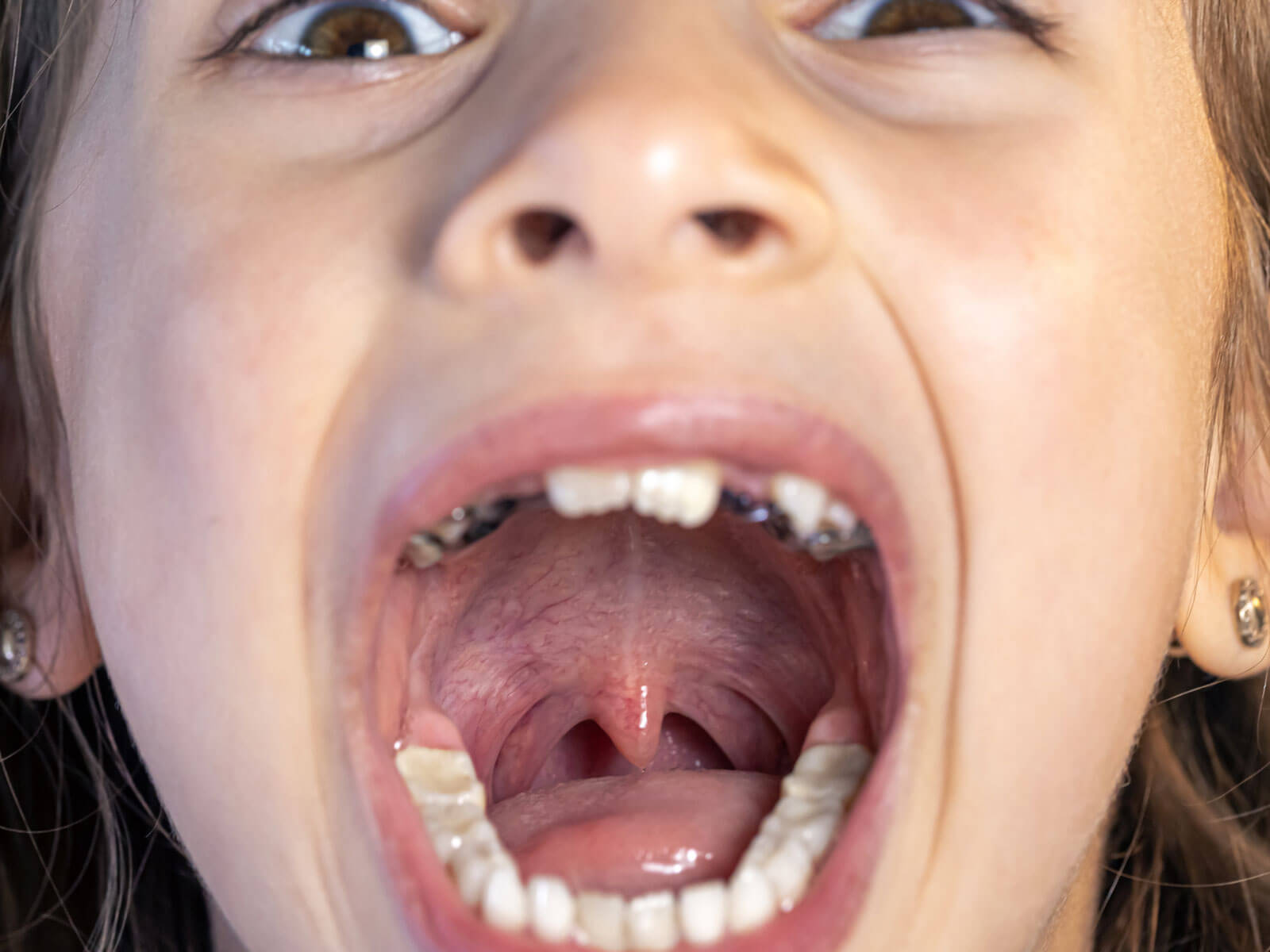 Dentinogenesis Imperfecta: Causes, Symptoms & Treatment